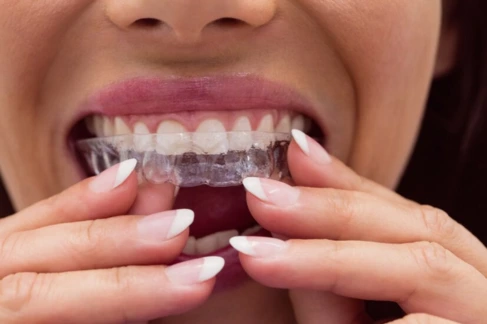 Why Invisalign is the Top Choice for Teeth Straightening in Livermore, CA